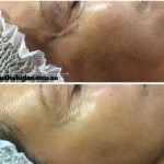 Dermapen 3 Before and After Image for Skin Rejuvenation