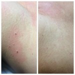 Before and After Skin Tag Removal